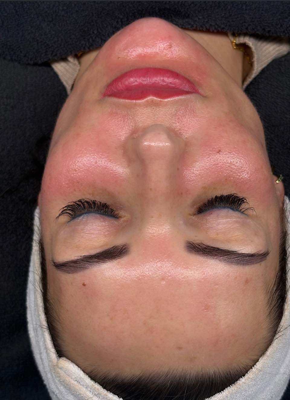 na-peeling